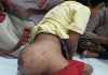 Penderita Tumor Ganas di Banten Butuh Uluran Tangan Dermawan