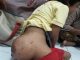 Penderita Tumor Ganas di Banten Butuh Uluran Tangan Dermawan